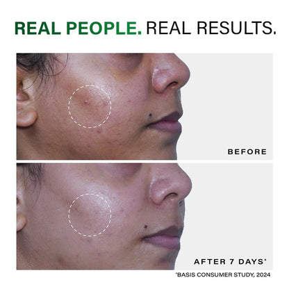 Novology Acne Clearing Foaming Cleanser, Facewash For Pimples, Sensitive Skin, Dermat Tested