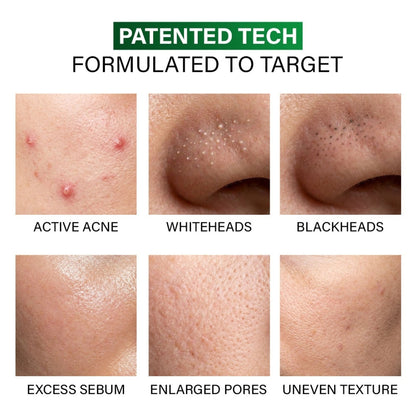 Novology Acne Clearing Foaming Cleanser, Facewash For Pimples, Sensitive Skin, Dermat Tested