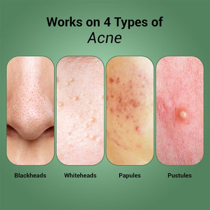 Sereko Pore-Clearing Face Wash with 1% Salicylic Acid, 2% Glycolic Acid for Active Acne,Oil Control