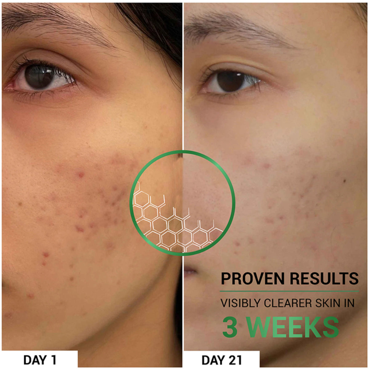 Sereko Pore-Clearing Face Wash with 1% Salicylic Acid, 2% Glycolic Acid for Active Acne,Oil Control