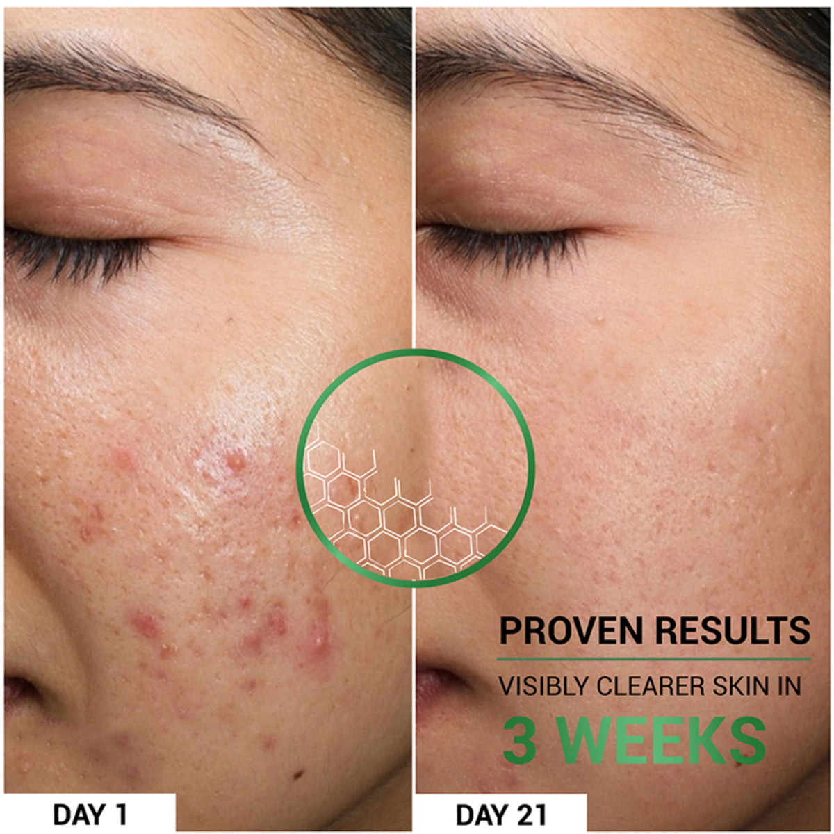 Sereko Oil Clear Face Moisturizer with Lactic Acid & NMF for Oily, Acne-Prone & Combination Skin