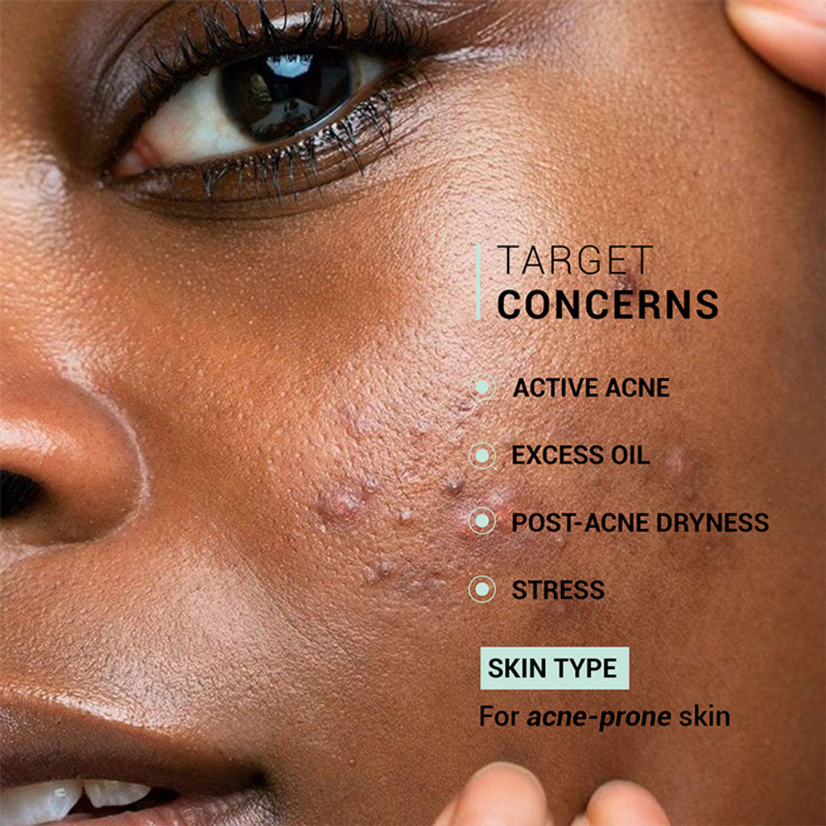 Sereko Oil Clear Face Moisturizer with Lactic Acid & NMF for Oily, Acne-Prone & Combination Skin