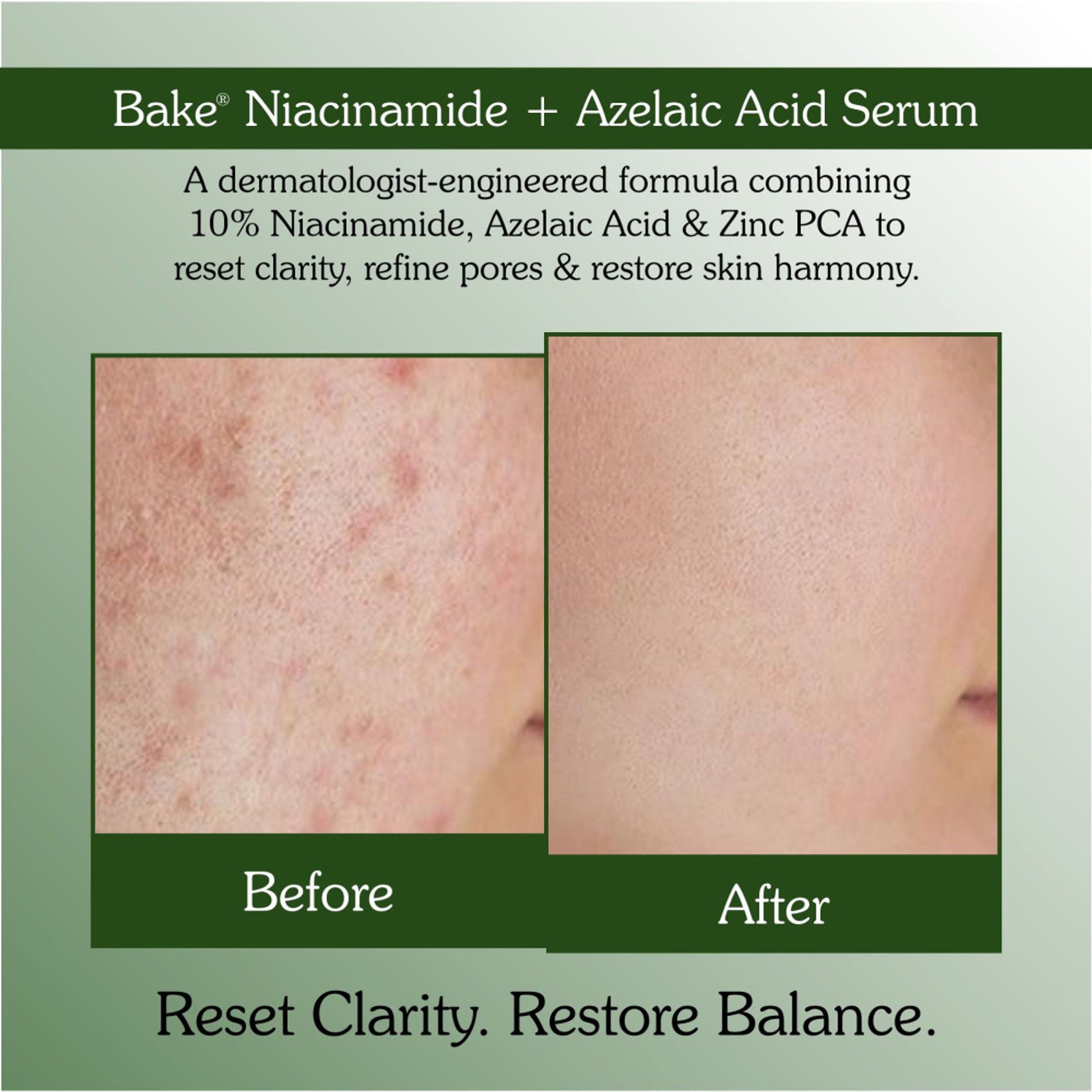 Bake 10% Niacinamide & Azelaic Acid Face Serum For Acne Scars & Dark Spots