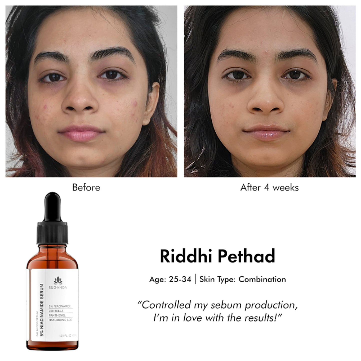 Suganda 5% Niacinamide Face Serum For Acne & Acne Marks, Blemishes, Pigmentation & Enlarged Pores