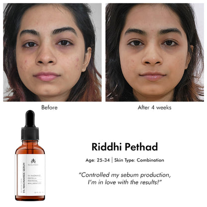 Suganda 5% Niacinamide Face Serum For Acne & Acne Marks, Blemishes, Pigmentation & Enlarged Pores