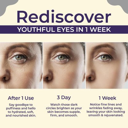 Sanfe Brighten & Conceal Undereye Cream, Dark Circles & Wrinkles Removal, Hyaluronic Acid & Collagen
