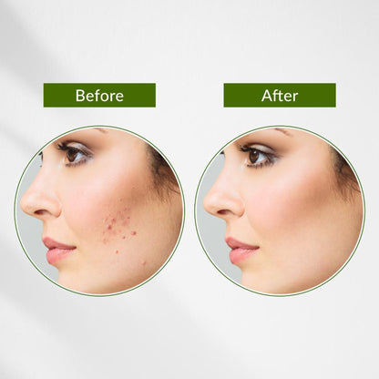 Lotus Botanicals Neem, Tulsi & Salicylic Acid Anti-Acne Purifying Face Gel