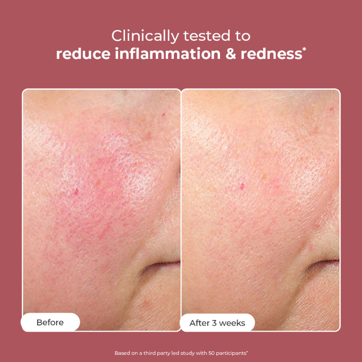 Conscious Chemist 10% Azelaic Acid Gel Cream for redness relief and acne treatment, shown in a tube with product packaging.