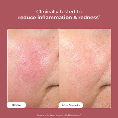 Conscious Chemist 10% Azelaic Acid Gel Cream for redness relief and acne treatment, shown in a tube with product packaging.