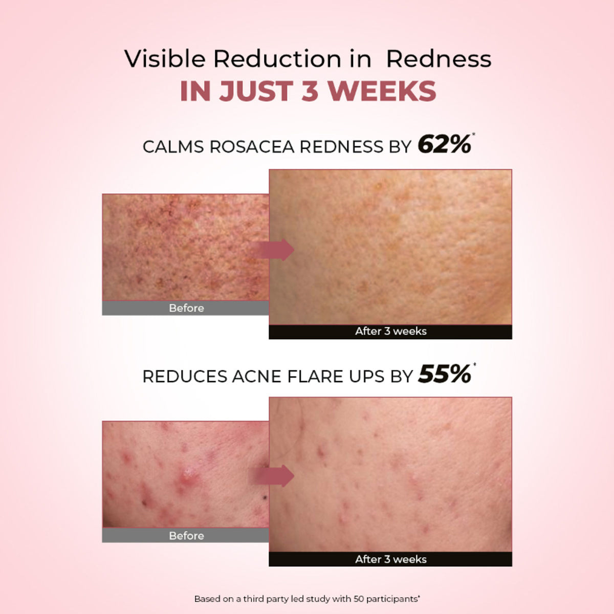 Conscious Chemist 10% Azelaic Acid Gel Cream for redness relief and acne treatment, showing the product tube and packaging.