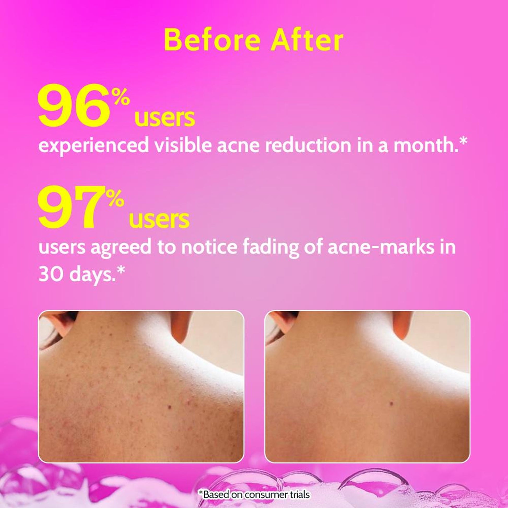 Chemist At Play 1% Salicylic Acid Acne Control Body Wash For Back And Body Acne And Back Acne