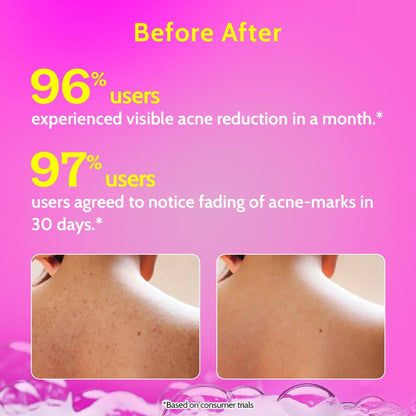 Chemist At Play 1% Salicylic Acid Acne Control Body Wash For Back And Body Acne And Back Acne