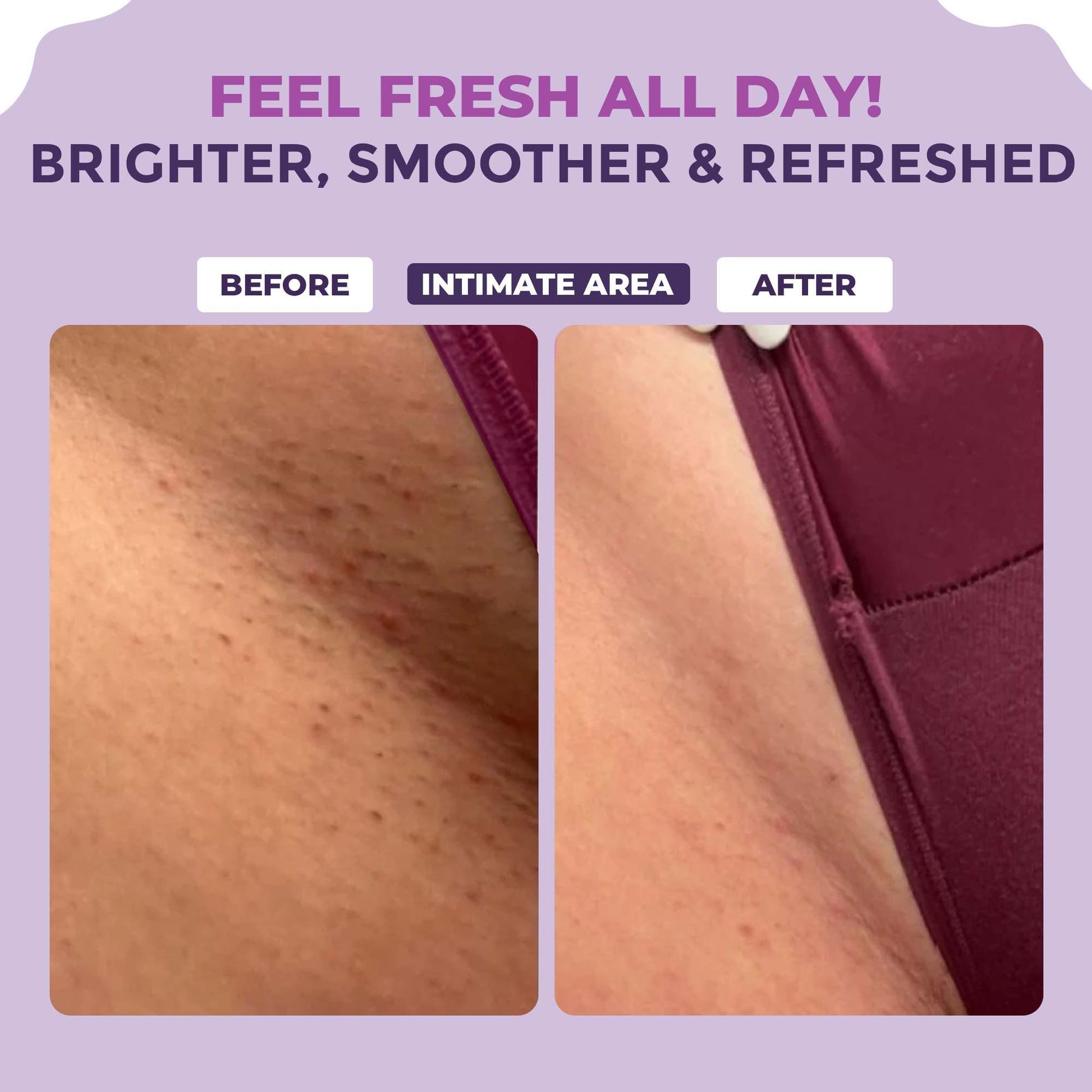 Sanfe Spotlite Sensitive Body Serum For Dark Underarms, 2% Glycolic Acid & 4% Niacinamide