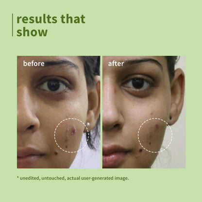 Plum Green Tea Pore Cleansing Gel Face Wash With Glycolic Acid - Fights Pimpels & Control Oil