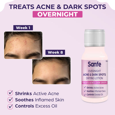 Sanfe Overnight Acne Drying Lotion, Salicylic Acid & Calamine Acne Spot Corrector, Pimple Clearing