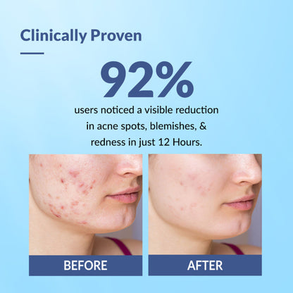 Fixderma Salyzap 2% Salicylic Acid Acne Spot Corrector gel with niacinamide for pimples and blemishes on clear skin.