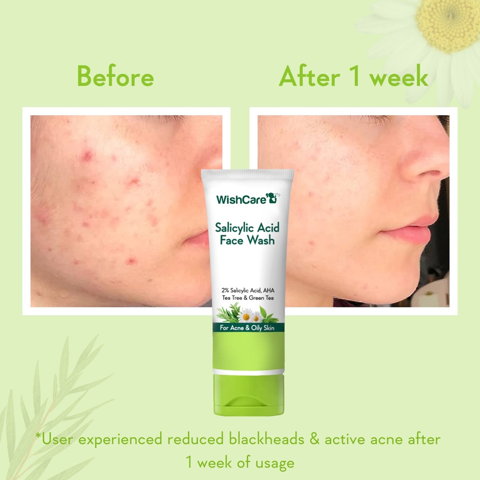 WishCare 2% Salicylic Acid Face Wash with AHA, Greentea & Tea Tree -Oil Control-Reduces Sebum & Acne