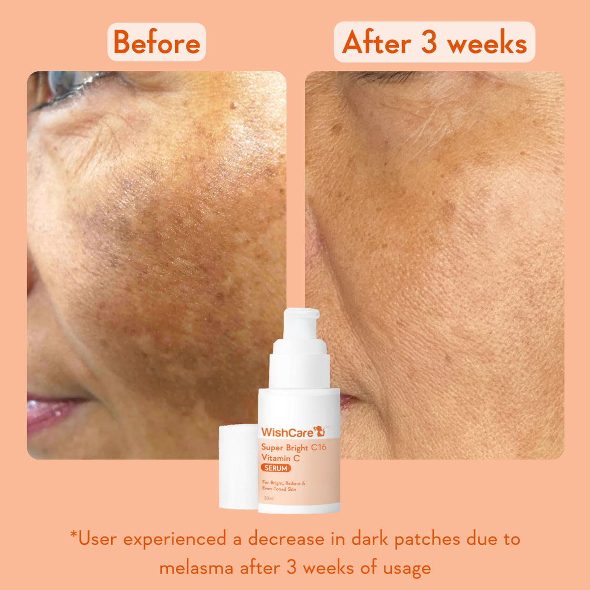 WishCare Super Bright C16 Vitamin C Face Serum for Glowing Skin- Reduces Pigmentation & Dark Spots