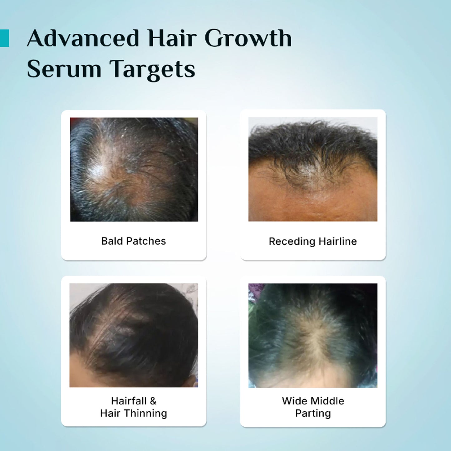 Pilgrim 3% Redensyl 4% Anagain Rosemary Korean Black Rice Advance Hair Growth Serum For Men & Women
