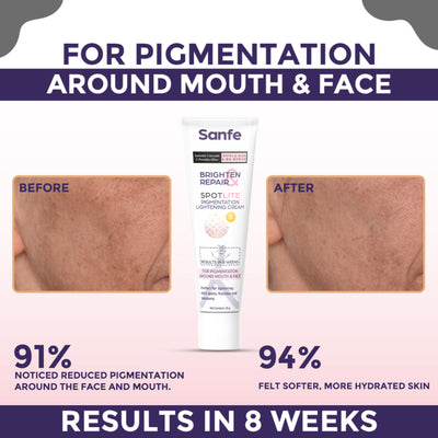 Sanfe Pigmentation Lightening Cream, Kojic Acid, Glutathione, Dark Spots Removal