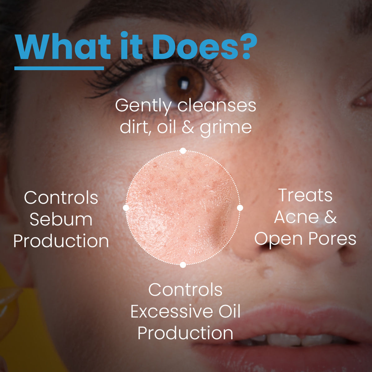 Fixderma Alpha Beta Acne Cleanser reducing pimples, controlling sebum, deep pore cleansing, non-comedogenic skincare product image