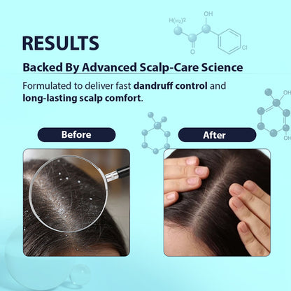 Dermistry Anti Dandruff Shampoo Piroctone Climbazole ZPTO for Oily Itchy Flaky Scalp Dry Frizzy Hair
