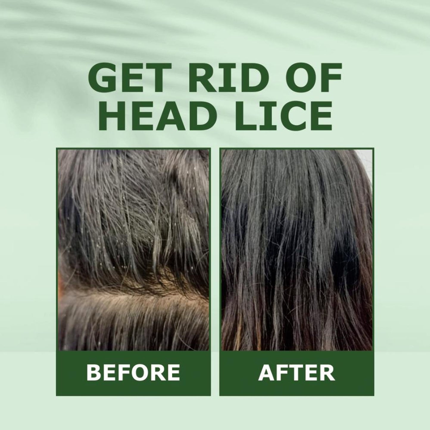 Nuerma Science Tea Tree Hair Oil for Anti Dandruff, Hair Fall Control & Itchiness Control