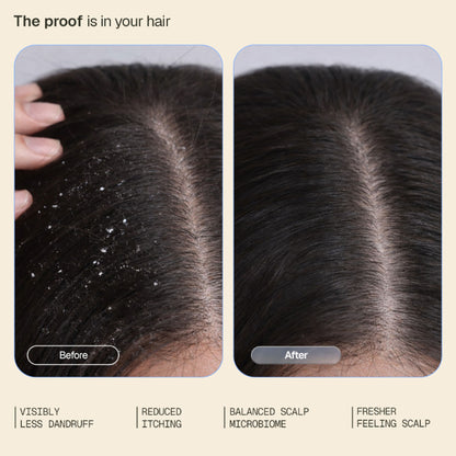 Arata Anti-Dandruff Shampoo, With Piroctone Olamine, Up To 100% Dandruff Reduction