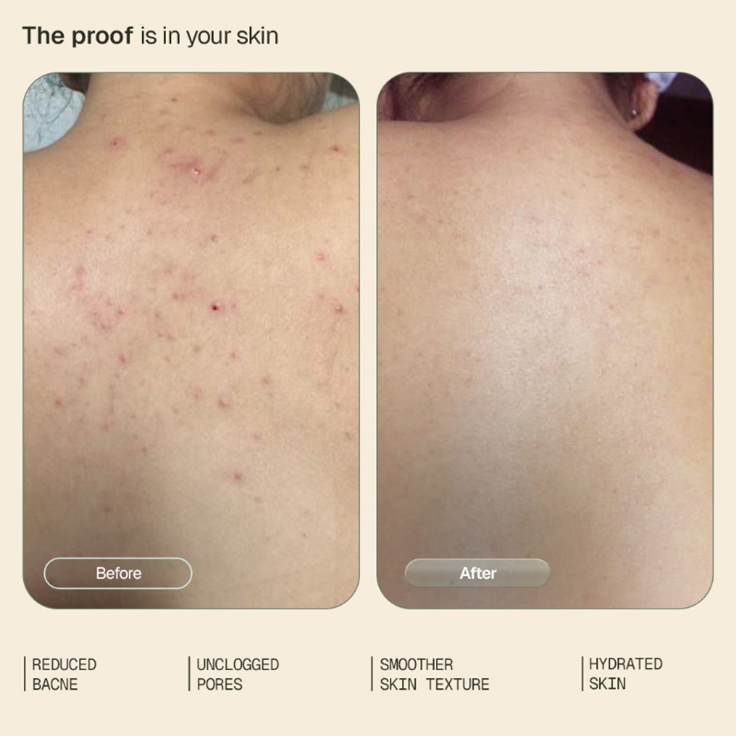 Arata 1% Salicylic Acid Daily Body Wash Exfoliates Clears Back Acne & Improves Strawberry Skin