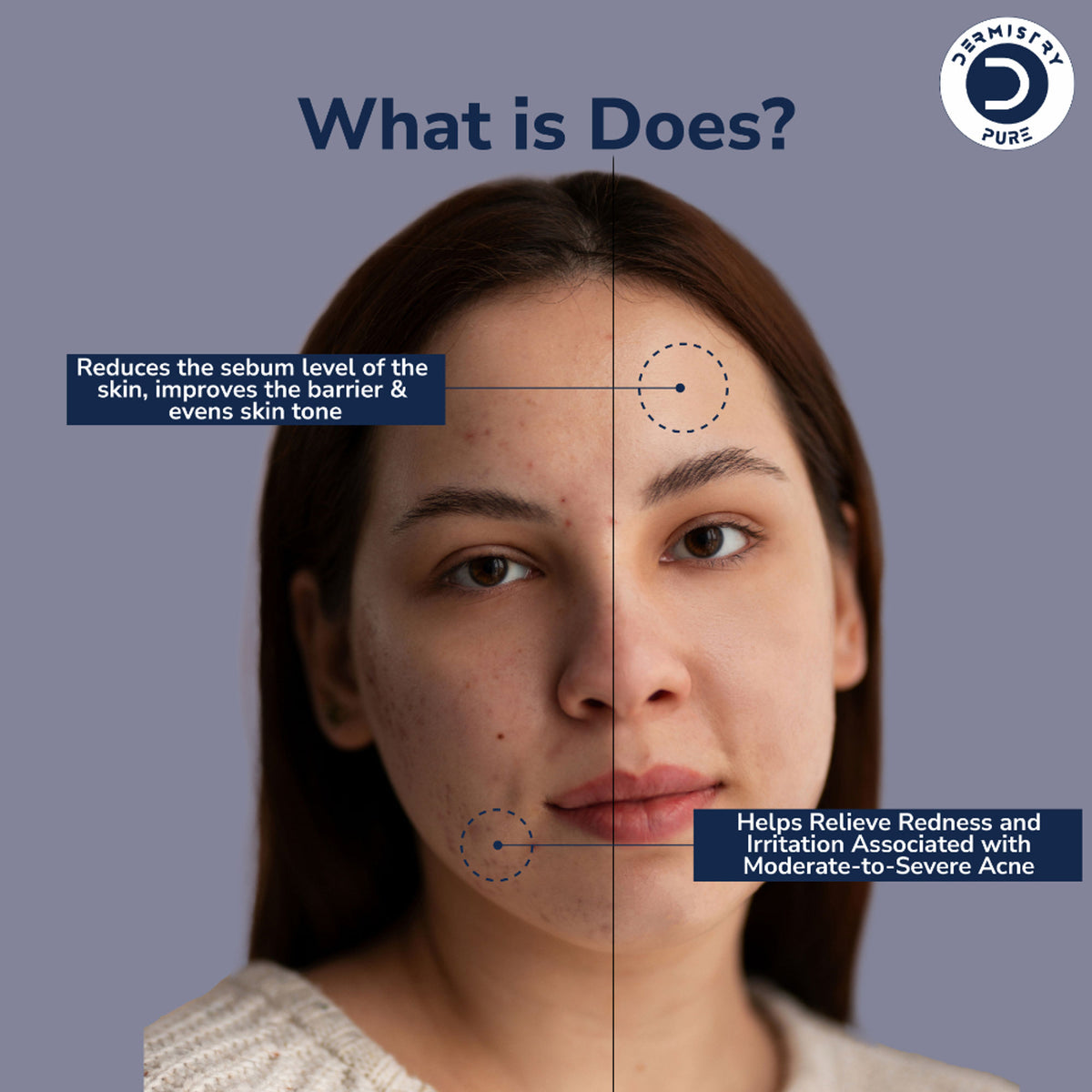 DERMISTRY 12% Niacinamide Zinc Oil Control Face Serum minimizing pores and scars, with a clear dropper and serum bottle.