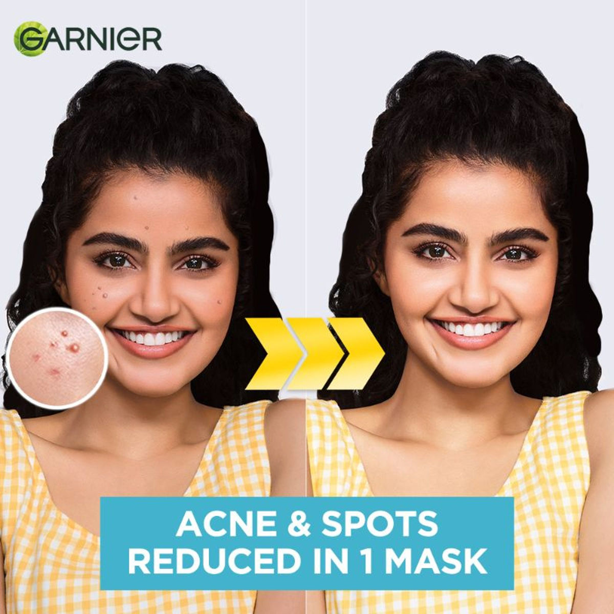 Garnier Bright Complete anti-pimple sheet mask with salicylic acid, niacinamide, and vitamin C serum on a skincare display.