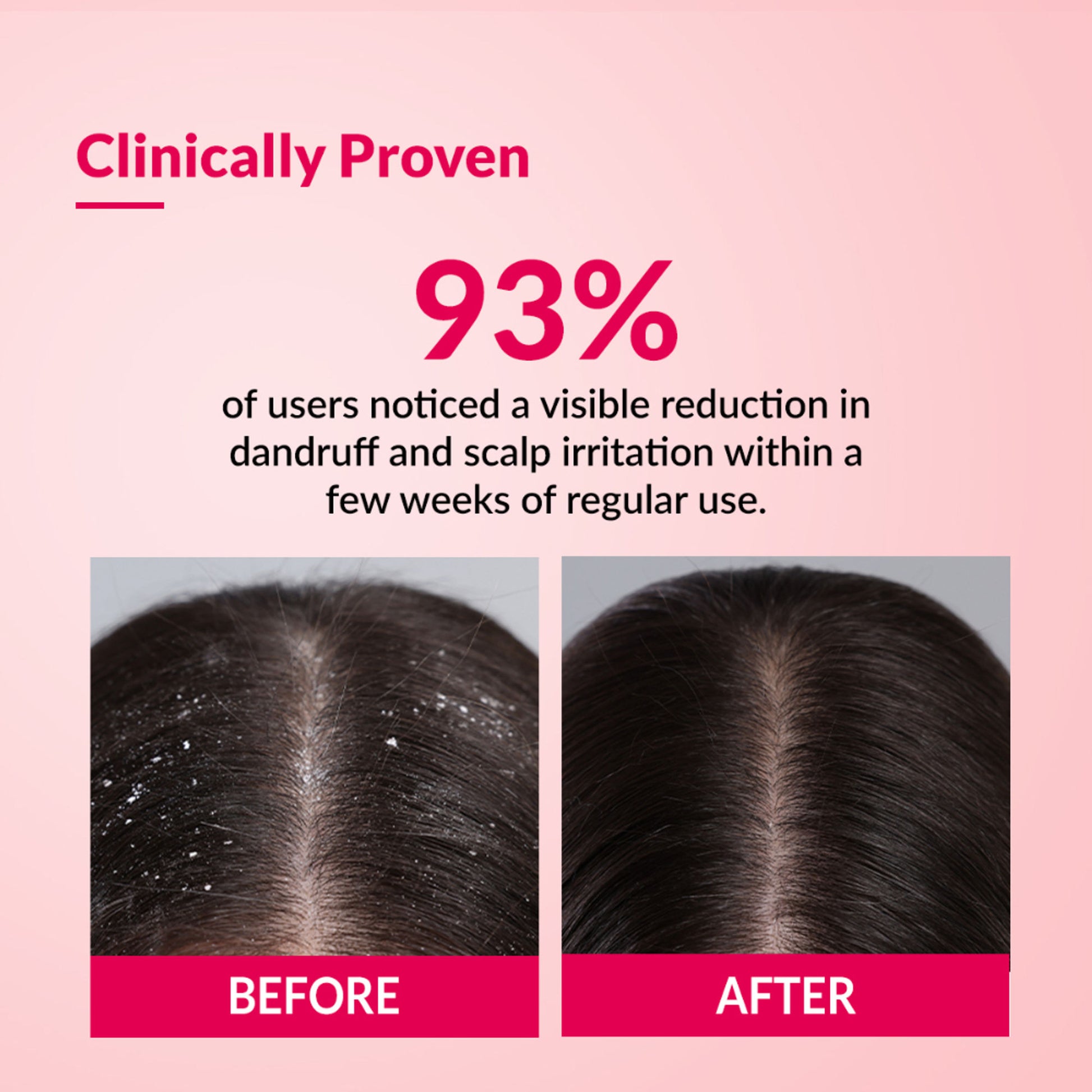 Fixderma BioteezS Anti Dandruff Shampoo, Flaky Scalp, Dry Scalp, Sulphate & Paraben Free