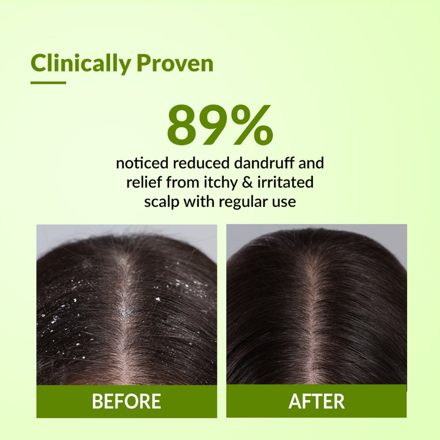 Fixderma Kairfoll Anti Dandruff Shampoo for Oily & Sensitive Prone Scalp, Sulphate Free