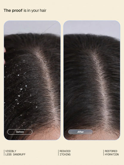 Anti-Dandruff System