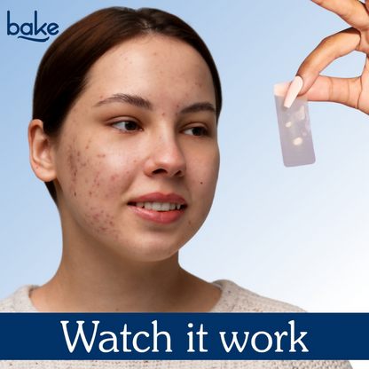Bake Acne Erase XL Pimple Patches