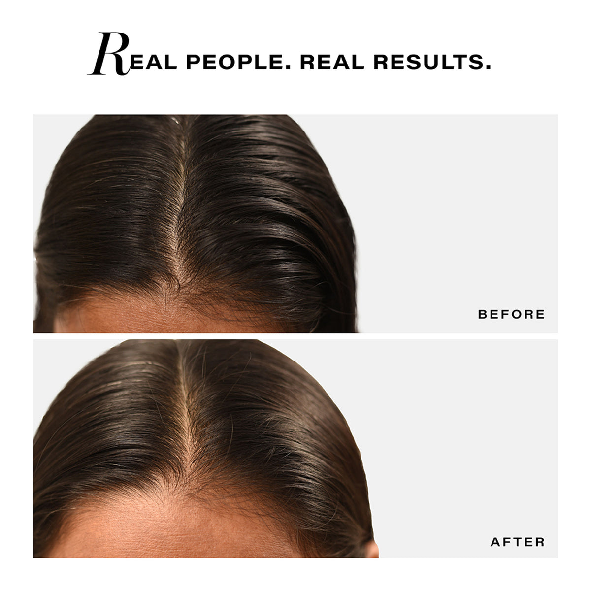 Novology Sebosys Control Scalp Serum, 48 Hours Oil Control, Dermat Tested, Oily, Greasy, Flaky Scalp