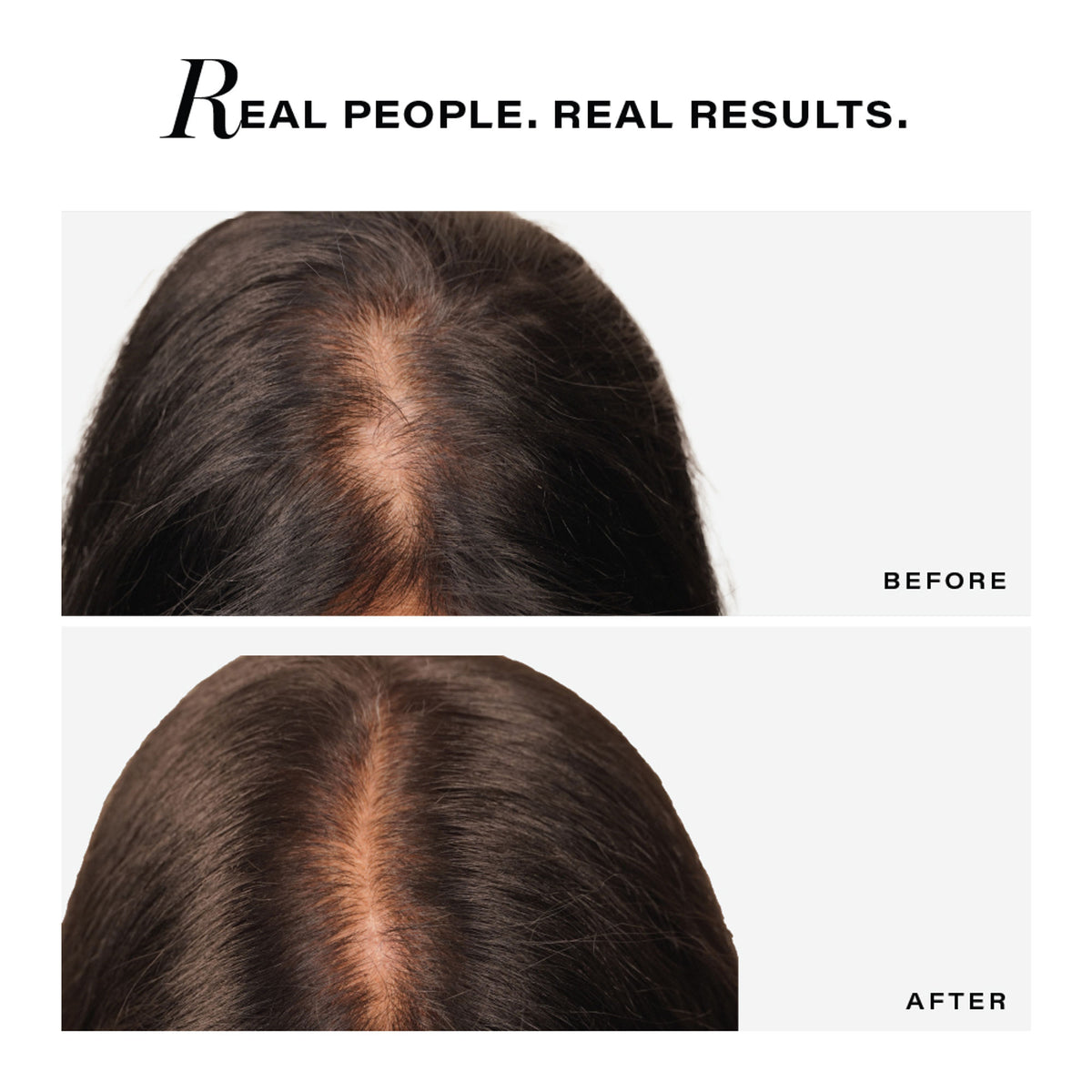 Novology Follicle Revive Scalp Serum, For Hair Growth, Suitable For Sensitive Scalp, Dermat Tested