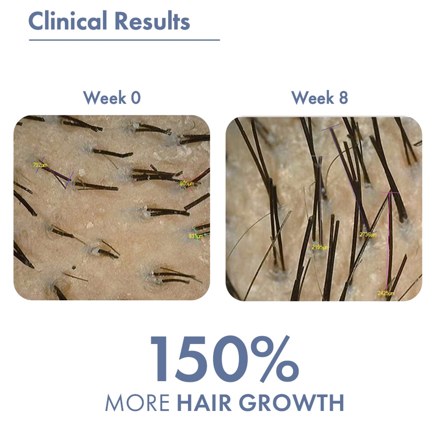 ThriveCo Hair Growth Serum with Redensyl, Rosemary, Procapil, AnaGain & Hyaluronic Acid