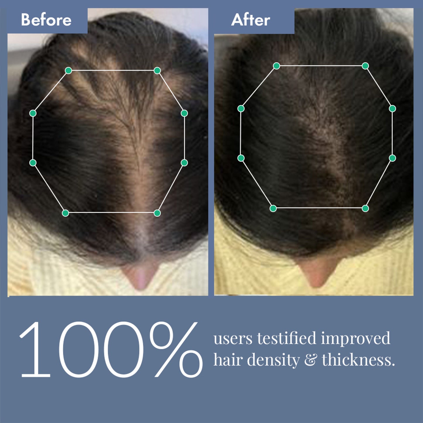 ThriveCo Hair Growth Serum with Redensyl, Rosemary, Procapil, AnaGain & Hyaluronic Acid