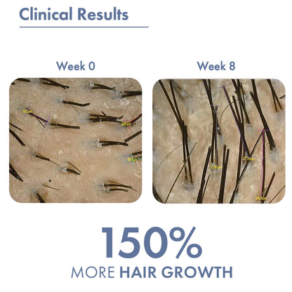 ThriveCo Hair Growth Serum Roll On with Redensyl, Rosemary, Procapil, AnaGain & Hyaluronic Acid, 10ml