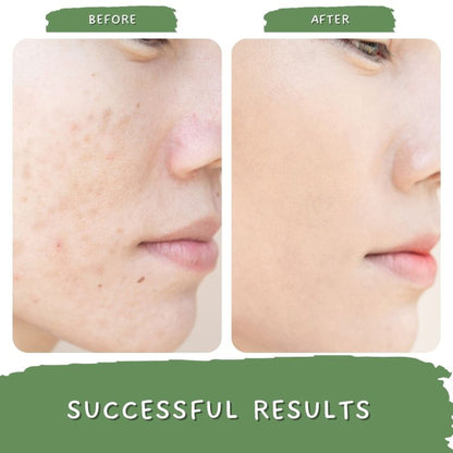 Mystiq Living Pigmentation Removal Cream, Brightening Day And Night Cream Kojic Acid, Niacinamide