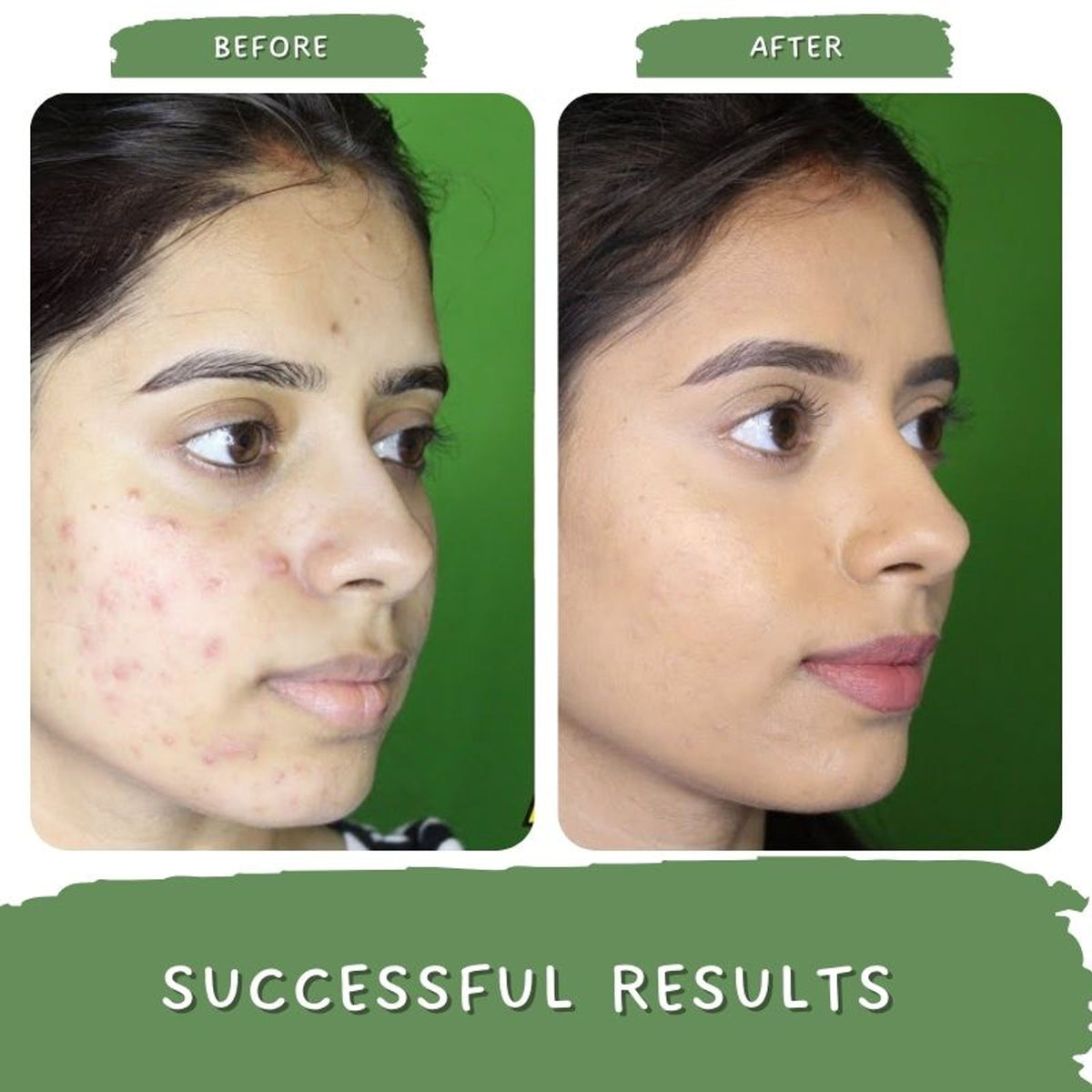 Mystiq Living Acne Gel Cream, Face Moisturizer For Oily Skin With Green Tea, Best Cream For Pimple