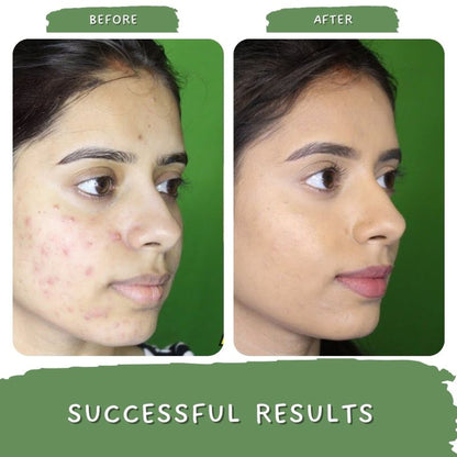 Mystiq Living Acne Gel Cream, Face Moisturizer For Oily Skin With Green Tea, Best Cream For Pimple