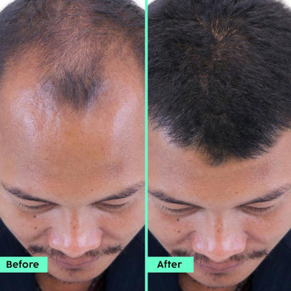Plix Rosemary Hair Growth Serum With 3% Redensyl, 4% AnaGain, 3% Baicapil, Thickens Hair
