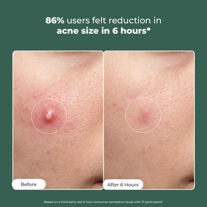 Conscious Chemist Rapid Relief Acne Spot Corrector Gel