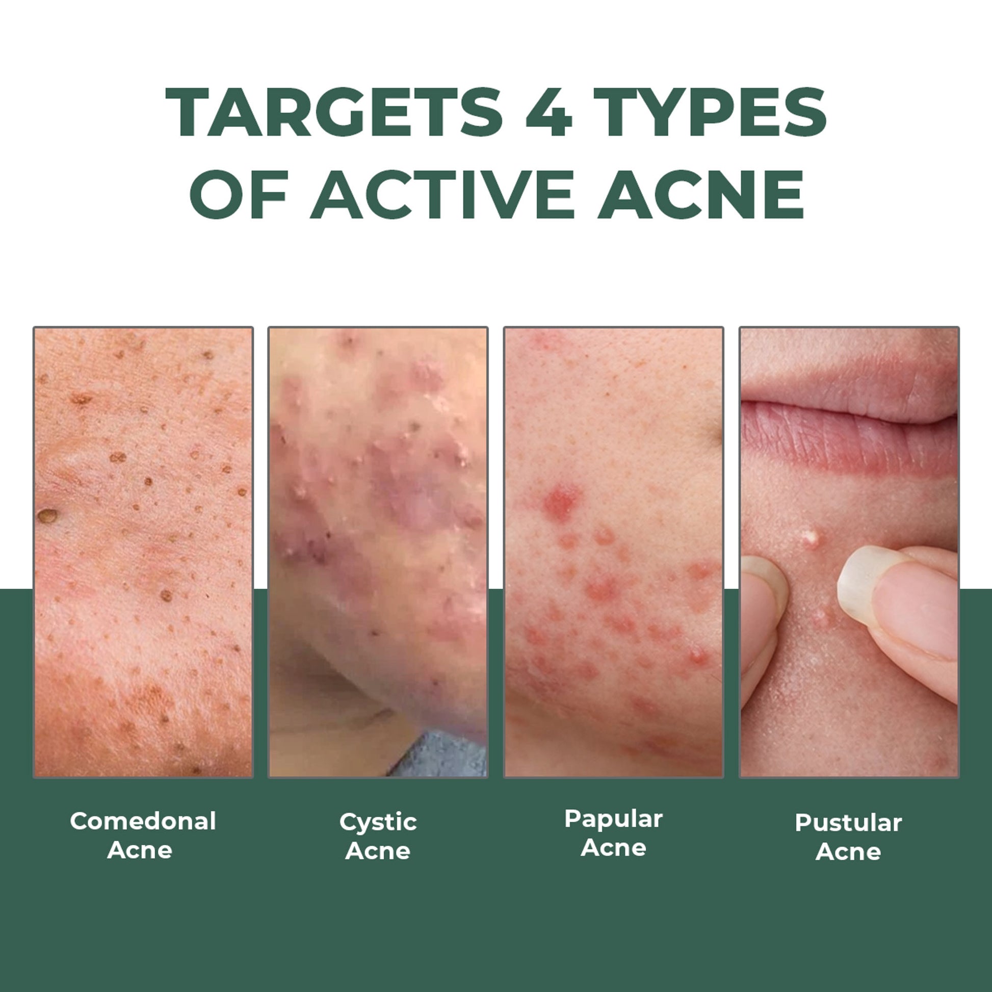 Conscious Chemist Rapid Relief Acne Spot Corrector Gel