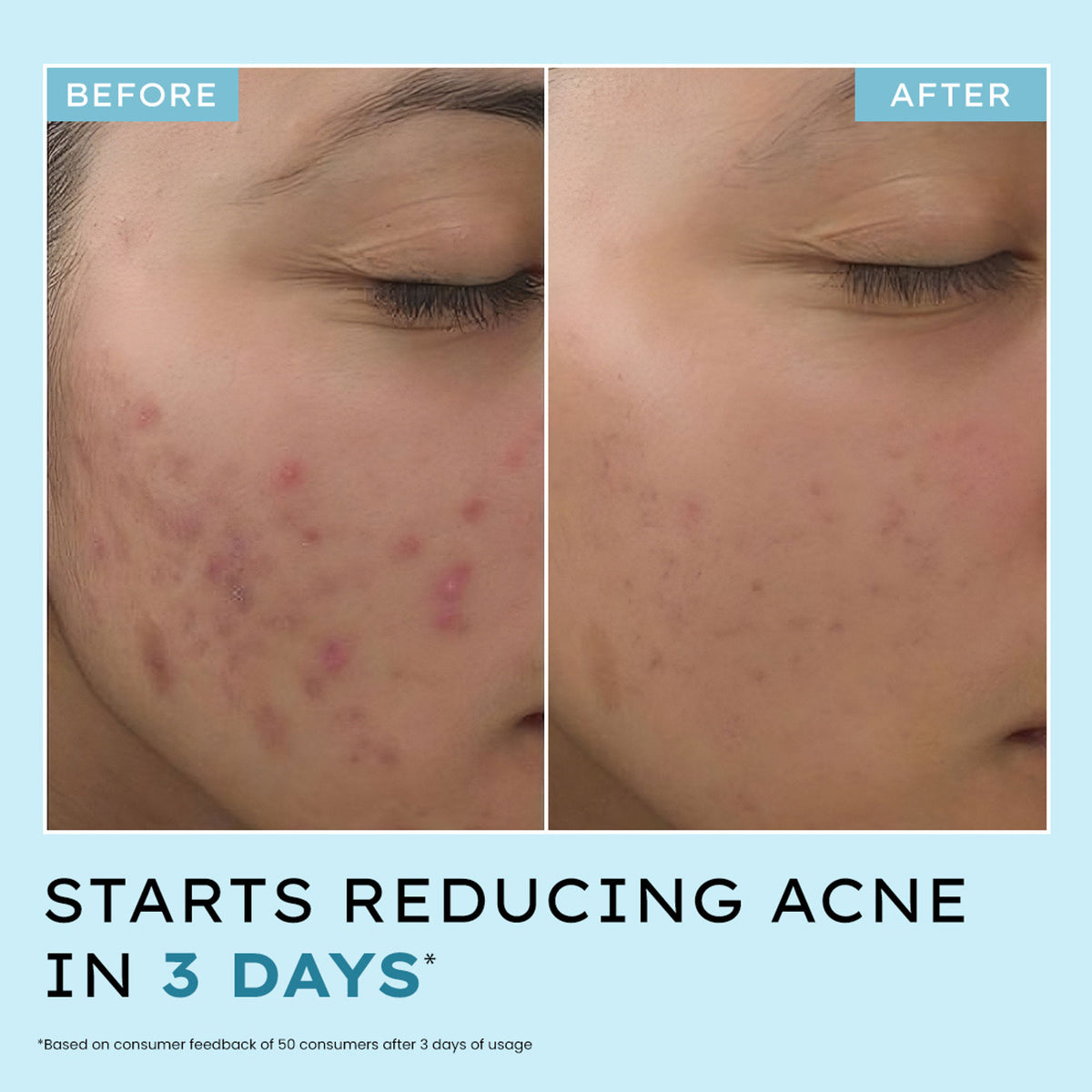 Hyphen Anti Acne face serum with azelaic and salicylic acids, tea tree extract, designed to reduce acne marks and clear skin.