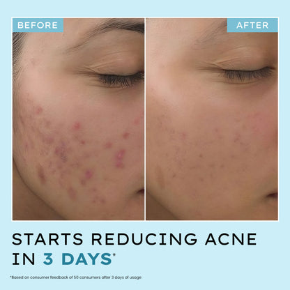 Hyphen Anti Acne face serum with azelaic and salicylic acids, tea tree extract, designed to reduce acne marks and clear skin.