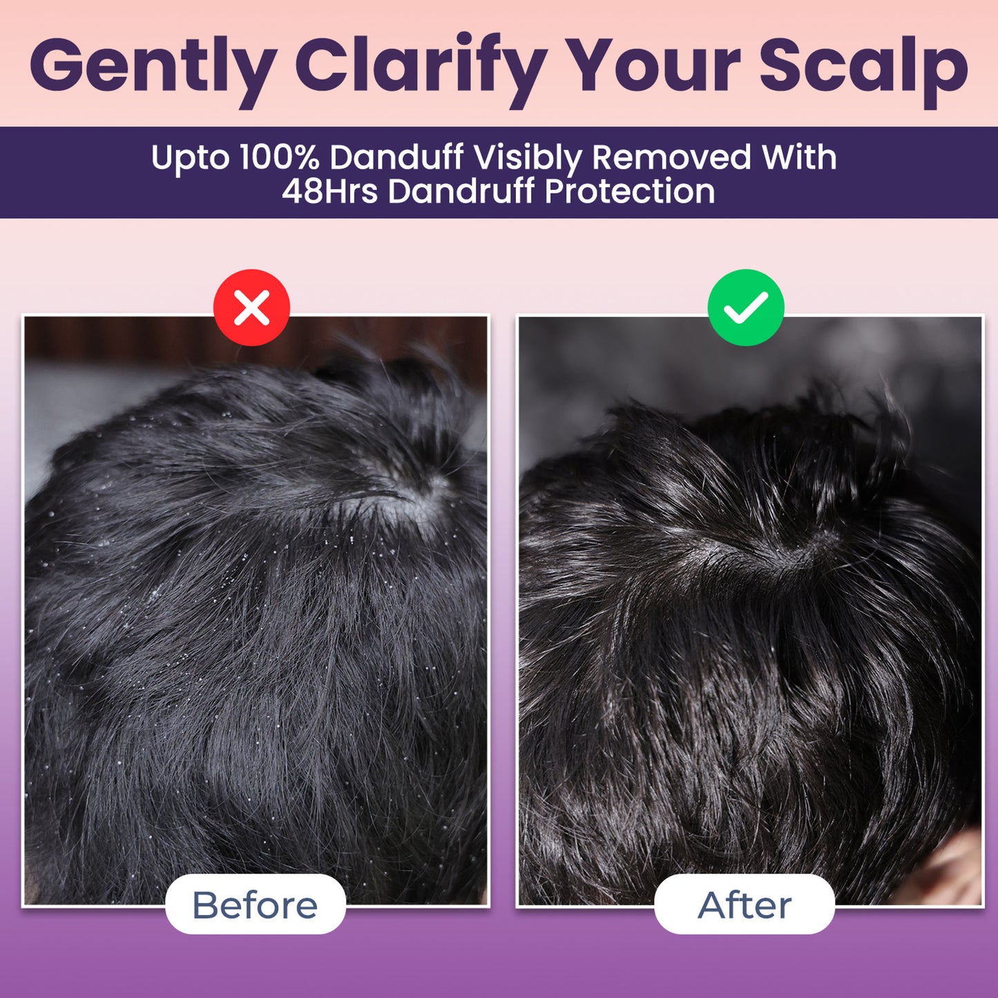 Sanfe Clear Scalp Gel, Anti-Dandruff & Flake Control Treatment, Reduces Scalp Itch