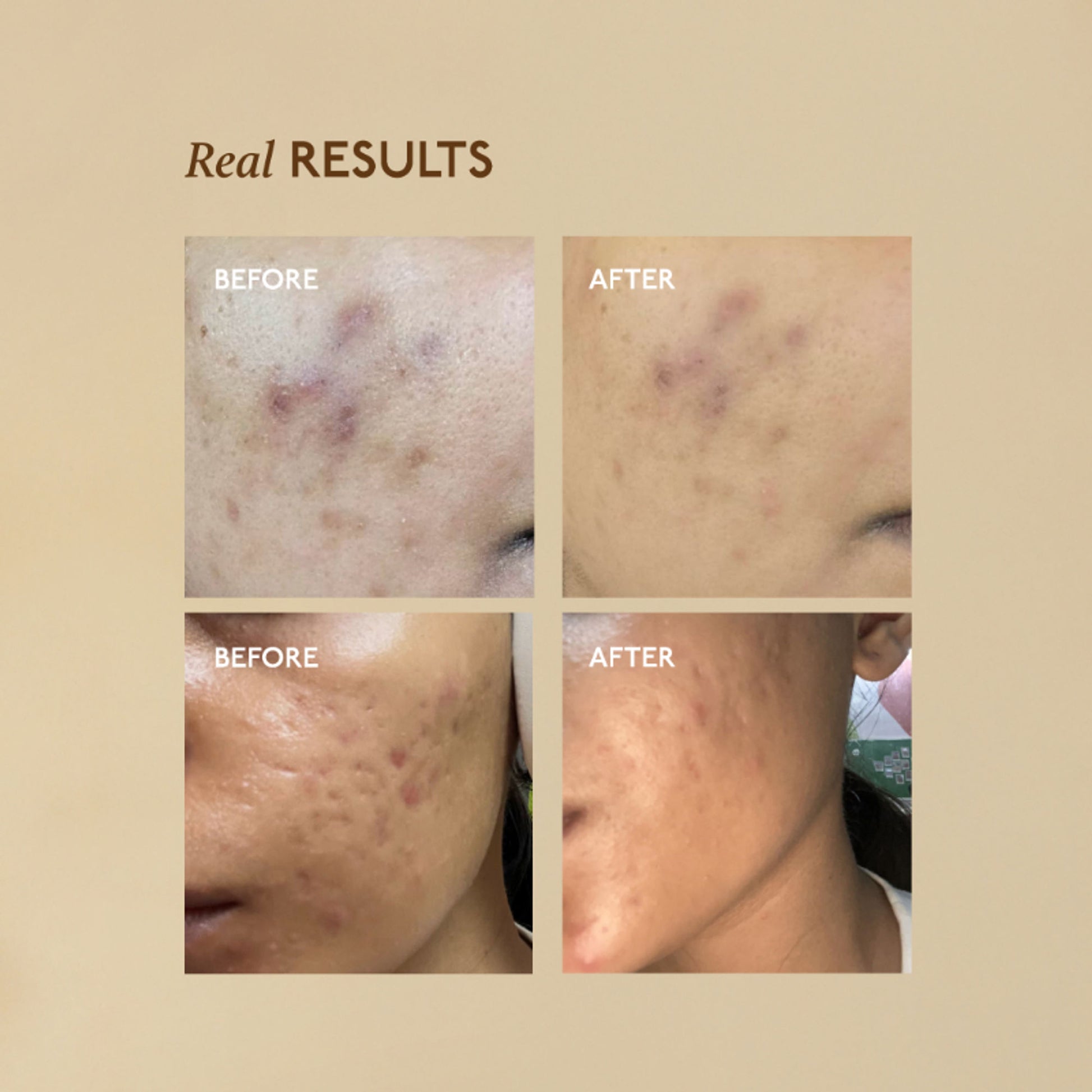 Asaya Advanced Dark Spot Pigmentation Face Serum for Men & Women with MelaMe Complex & Niacinamide